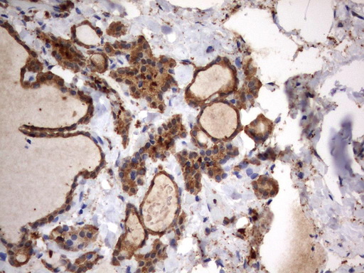 HMBS / PBGD Antibody - Immunohistochemical staining of paraffin-embedded Human thyroid tissue using anti-HMBS mouse monoclonal antibody.  heat-induced epitope retrieval by 10mM citric buffer, pH9.0, 120C for 3min)