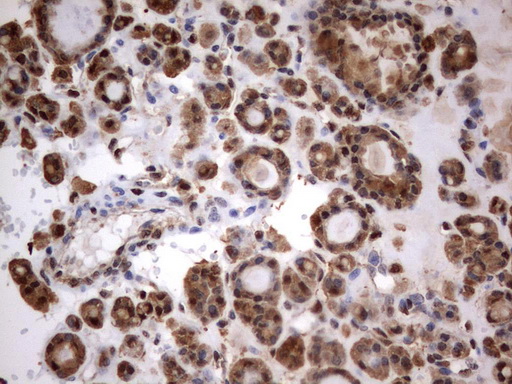 HMBS / PBGD Antibody - Immunohistochemical staining of paraffin-embedded Carcinoma of Human thyroid tissue using anti-HMBS mouse monoclonal antibody.  heat-induced epitope retrieval by 10mM citric buffer, pH9.0, 120C for 3min)