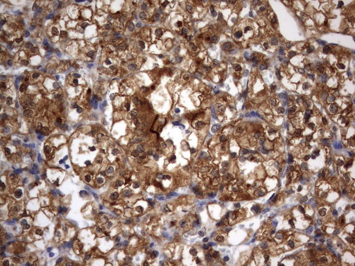 HMBS / PBGD Antibody - Immunohistochemical staining of paraffin-embedded Carcinoma of Human kidney tissue using anti-HMBS mouse monoclonal antibody.  heat-induced epitope retrieval by 10mM citric buffer, pH9.0, 120C for 3min)