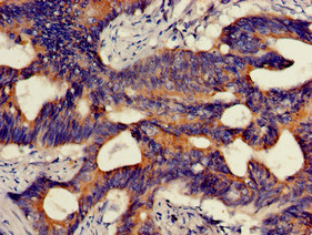 HMBS / PBGD Antibody - Immunohistochemistry of paraffin-embedded human colon cancer using HMBS Antibody at dilution of 1:100