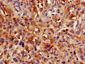 HMBS / PBGD Antibody - Immunohistochemistry of paraffin-embedded human melanoma cancer using HMBS Antibody at dilution of 1:100
