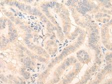 HMBS / PBGD Antibody - Immunohistochemistry of paraffin-embedded Human thyroid cancer tissue  using HMBS Polyclonal Antibody at dilution of 1:25(×200)
