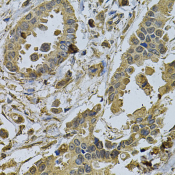 HMG-CoA Reductase / HMGCR Antibody - Immunohistochemistry of paraffin-embedded human breast cancer using HMGCR Antibody at dilution of 1:100 (40x lens).