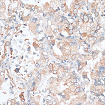 HMG-CoA Reductase / HMGCR Antibody - Immunohistochemistry of paraffin-embedded human lung cancer using HMGCR antibody at dilution of 1:100 (40x lens).