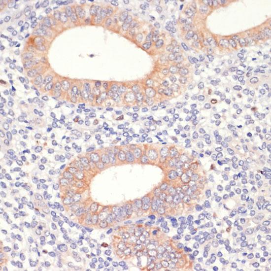 HMG-CoA Reductase / HMGCR Antibody - Immunohistochemistry of paraffin-embedded Human uterine cancer using HMGCR Polyclonal Antibody at dilution of 1:200 (40x lens).