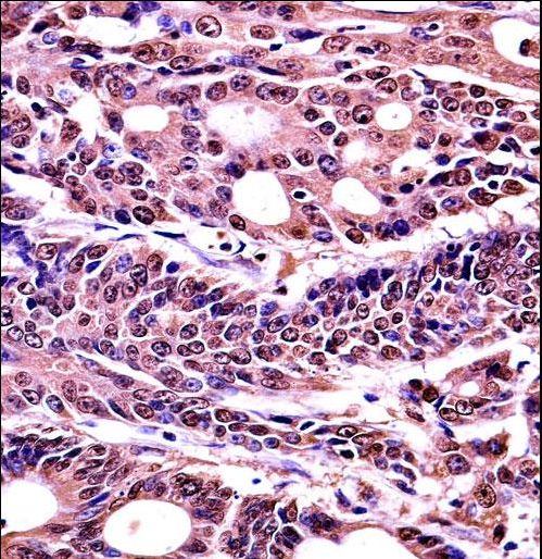 HMG1 / HMGB1 Antibody - HMGB1 Antibody (Ascites) immunohistochemistry of formalin-fixed and paraffin-embedded human colon carcinoma followed by peroxidase-conjugated secondary antibody and DAB staining.This data demonstrates the use of HMGB1 Antibody (Ascites) for immunohistochemistry.