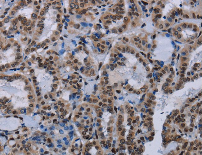 HMG1 / HMGB1 Antibody - Immunohistochemistry of paraffin-embedded Human thyroid cancer using HMGB1 Polyclonal Antibody at dilution of 1:30.