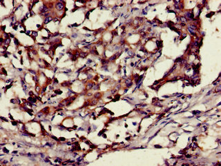 HMG1 / HMGB1 Antibody - Immunohistochemistry of paraffin-embedded human gastric cancer using HMGB1 Antibody at dilution of 1:100