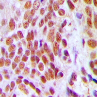HMG2 / HMGB2 Antibody - Immunohistochemical analysis of HMGB2 staining in human breast cancer formalin fixed paraffin embedded tissue section. The section was pre-treated using heat mediated antigen retrieval with sodium citrate buffer (pH 6.0). The section was then incubated with the antibody at room temperature and detected with HRP and DAB as chromogen. The section was then counterstained with hematoxylin and mounted with DPX.
