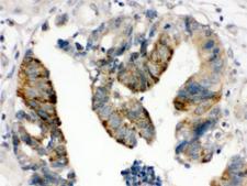 HMG2 / HMGB2 Antibody - IHC testing of FFPE human intestinal cancer tissue with HMGB2 antibody at 1ug/ml. HIER: steam in pH6 citrate buffer and allow to cool prior to staining.