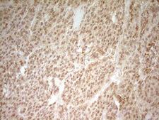 HMG20A Antibody - Immunohistochemical staining of paraffin-embedded Carcinoma of Human lung tissue using anti-HMG20A mouse monoclonal antibody. (Heat-induced epitope retrieval by 1 mM EDTA in 10mM Tris, pH8.5, 120C for 3min,