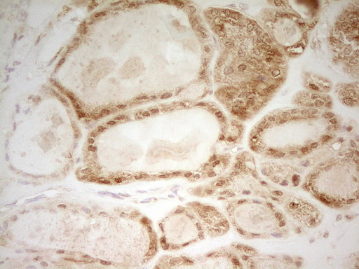 HMG20A Antibody - Immunohistochemical staining of paraffin-embedded Carcinoma of Human thyroid tissue using anti-HMG20A mouse monoclonal antibody. (Heat-induced epitope retrieval by 1 mM EDTA in 10mM Tris, pH8.5, 120C for 3min,