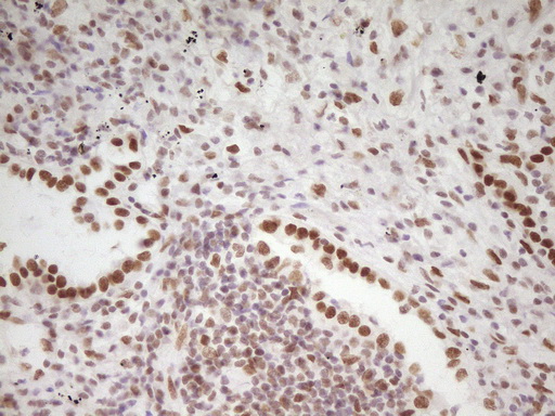 HMG20A Antibody - Immunohistochemical staining of paraffin-embedded Carcinoma of Human lung tissue using anti-HMG20A mouse monoclonal antibody. (Heat-induced epitope retrieval by 1 mM EDTA in 10mM Tris, pH8.5, 120C for 3min,