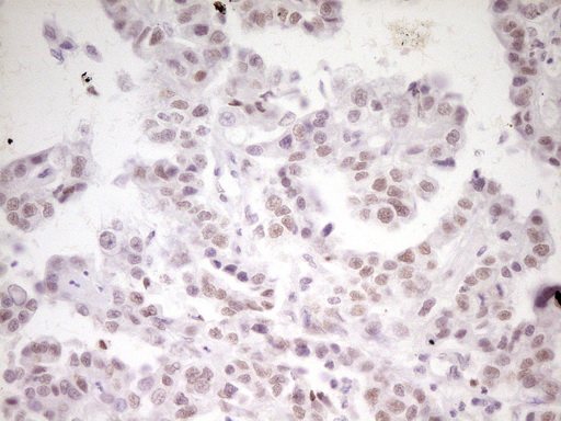 HMG20A Antibody - Immunohistochemical staining of paraffin-embedded Adenocarcinoma of Human ovary tissue using anti-HMG20A mouse monoclonal antibody. (Heat-induced epitope retrieval by 1 mM EDTA in 10mM Tris, pH8.5, 120C for 3min,