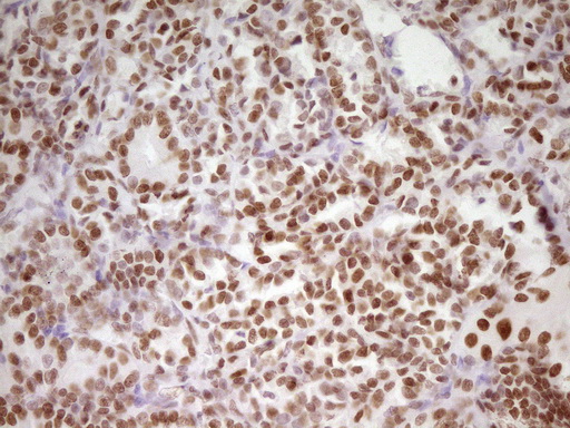 HMG20A Antibody - Immunohistochemical staining of paraffin-embedded Carcinoma of Human thyroid tissue using anti-HMG20A mouse monoclonal antibody. (Heat-induced epitope retrieval by 1 mM EDTA in 10mM Tris, pH8.5, 120C for 3min,