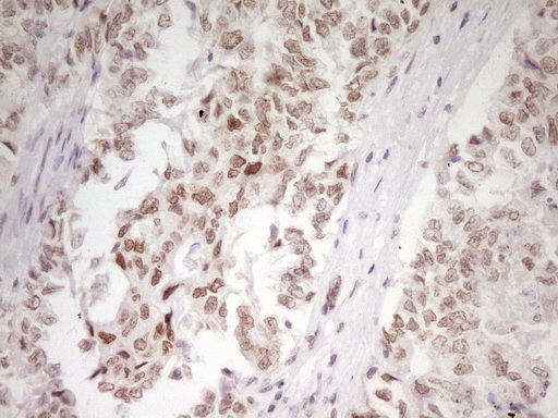 HMG20A Antibody - Immunohistochemical staining of paraffin-embedded Adenocarcinoma of Human endometrium tissue using anti-HMG20A mouse monoclonal antibody. (Heat-induced epitope retrieval by 1 mM EDTA in 10mM Tris, pH8.5, 120C for 3min,