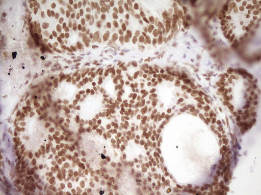 HMG20A Antibody - Immunohistochemical staining of paraffin-embedded Adenocarcinoma of Human breast tissue using anti-HMG20A mouse monoclonal antibody. (Heat-induced epitope retrieval by 1 mM EDTA in 10mM Tris, pH8.5, 120C for 3min,