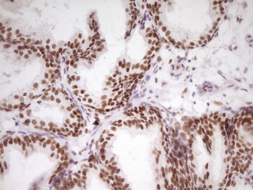 HMG20A Antibody - Immunohistochemical staining of paraffin-embedded Carcinoma of Human prostate tissue using anti-HMG20A mouse monoclonal antibody. (Heat-induced epitope retrieval by 1 mM EDTA in 10mM Tris, pH8.5, 120C for 3min,