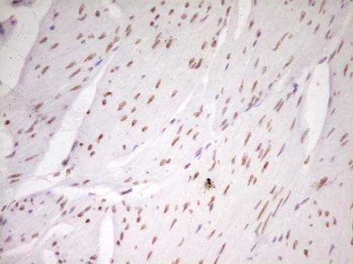 HMG20A Antibody - Immunohistochemical staining of paraffin-embedded Carcinoma of Human bladder tissue using anti-HMG20A mouse monoclonal antibody. (Heat-induced epitope retrieval by 1 mM EDTA in 10mM Tris, pH8.5, 120C for 3min,