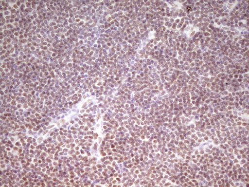 HMG20A Antibody - Immunohistochemical staining of paraffin-embedded Human lymphoma tissue using anti-HMG20A mouse monoclonal antibody. (Heat-induced epitope retrieval by 1 mM EDTA in 10mM Tris, pH8.5, 120C for 3min,