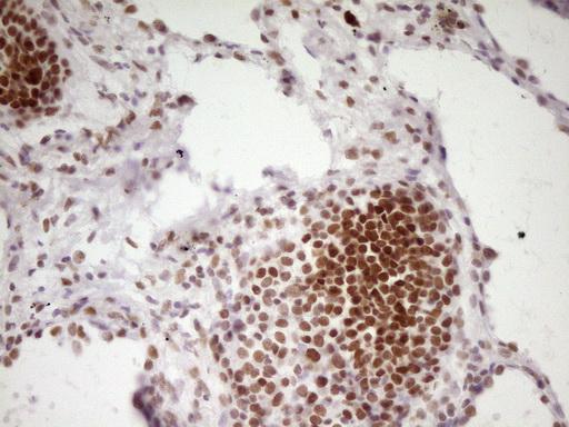 HMG20A Antibody - Immunohistochemical staining of paraffin-embedded Human lung tissue within the normal limits using anti-HMG20A mouse monoclonal antibody. (Heat-induced epitope retrieval by 1 mM EDTA in 10mM Tris, pH8.5, 120C for 3min,