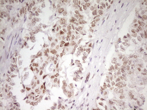 HMG20A Antibody - IHC of paraffin-embedded Adenocarcinoma of Human endometrium tissue using anti-HMG20A mouse monoclonal antibody. (Heat-induced epitope retrieval by 1 mM EDTA in 10mM Tris, pH8.5, 120°C for 3min).