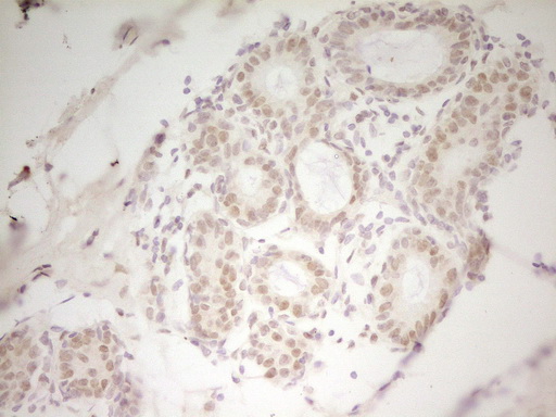 HMG20A Antibody - Immunohistochemical staining of paraffin-embedded Adenocarcinoma of Human breast tissue using anti-HMG20A mouse monoclonal antibody. (Heat-induced epitope retrieval by 1 mM EDTA in 10mM Tris, pH8.5, 120C for 3min,