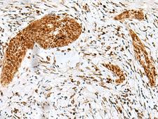 HMG20A Antibody - Immunohistochemistry of paraffin-embedded Human esophagus cancer tissue  using HMG20A Polyclonal Antibody at dilution of 1:25(×200)