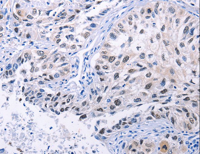 HMGB3 Antibody - Immunohistochemistry of paraffin-embedded Human lung cancer using HMGB3 Polyclonal Antibody at dilution of 1:20.