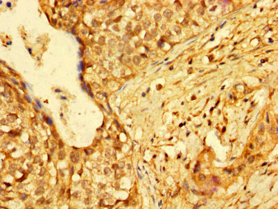 HMGB3 Antibody - Immunohistochemistry image at a dilution of 1:300 and staining in paraffin-embedded human cervical cancer performed on a Leica BondTM system. After dewaxing and hydration, antigen retrieval was mediated by high pressure in a citrate buffer (pH 6.0) . Section was blocked with 10% normal goat serum 30min at RT. Then primary antibody (1% BSA) was incubated at 4 °C overnight. The primary is detected by a biotinylated secondary antibody and visualized using an HRP conjugated SP system.