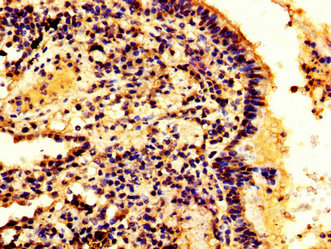 HMGB3 Antibody - Immunohistochemistry image at a dilution of 1:300 and staining in paraffin-embedded human lung cancer performed on a Leica BondTM system. After dewaxing and hydration, antigen retrieval was mediated by high pressure in a citrate buffer (pH 6.0) . Section was blocked with 10% normal goat serum 30min at RT. Then primary antibody (1% BSA) was incubated at 4 °C overnight. The primary is detected by a biotinylated secondary antibody and visualized using an HRP conjugated SP system.