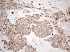 HMGB4 Antibody - Immunohistochemical staining of paraffin-embedded Adenocarcinoma of Human endometrium tissue using anti-HMGB4 mouse monoclonal antibody. (Heat-induced epitope retrieval by 1mM EDTA in 10mM Tris buffer. (pH8.5) at 120°C for 3 min. (1:150)