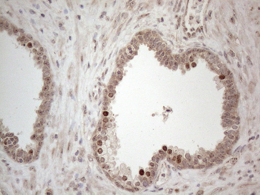 HMGB4 Antibody - Immunohistochemical staining of paraffin-embedded Carcinoma of Human prostate tissue using anti-HMGB4 mouse monoclonal antibody. (Heat-induced epitope retrieval by 1mM EDTA in 10mM Tris buffer. (pH8.5) at 120°C for 3 min. (1:150)
