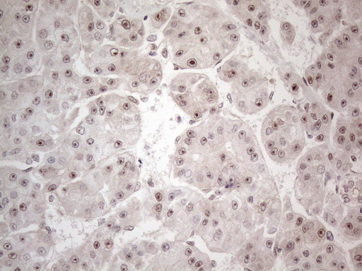 HMGB4 Antibody - Immunohistochemical staining of paraffin-embedded Carcinoma of Human liver tissue using anti-HMGB4 mouse monoclonal antibody. (Heat-induced epitope retrieval by 1mM EDTA in 10mM Tris buffer. (pH8.5) at 120°C for 3 min. (1:150)