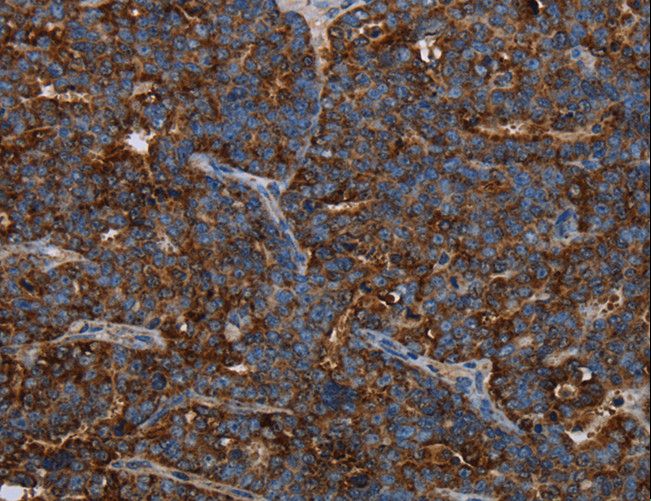 HMGCL Antibody - Immunohistochemistry of paraffin-embedded Human ovarian cancer using HMGCL Polyclonal Antibody at dilution of 1:30.