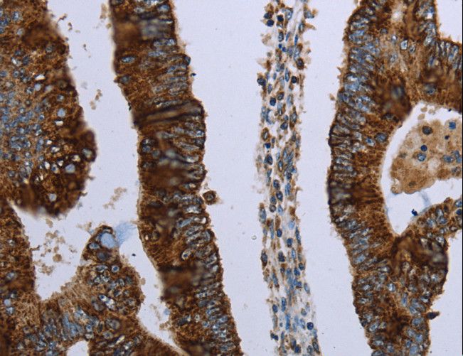 HMGCL Antibody - Immunohistochemistry of paraffin-embedded Human colon cancer using HMGCL Polyclonal Antibody at dilution of 1:30.