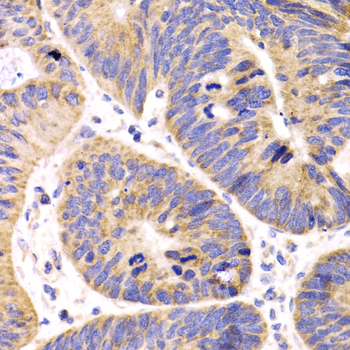 HMGCL Antibody - Immunohistochemistry of paraffin-embedded human colon carcinoma tissue.