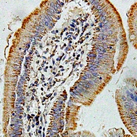 HMGCL Antibody - Immunohistochemical analysis of HMGCL staining in human colon cancer formalin fixed paraffin embedded tissue section. The section was pre-treated using heat mediated antigen retrieval with sodium citrate buffer (pH 6.0). The section was then incubated with the antibody at room temperature and detected using an HRP conjugated compact polymer system. DAB was used as the chromogen. The section was then counterstained with hematoxylin and mounted with DPX.