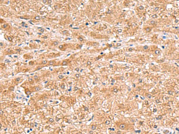 HMGCLL1 Antibody - Immunohistochemistry of paraffin-embedded Human liver cancer tissue  using HMGCLL1 Polyclonal Antibody at dilution of 1:70(×200)