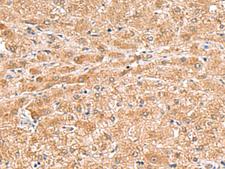 HMGCLL1 Antibody - Immunohistochemistry of paraffin-embedded Human liver cancer tissue  using HMGCLL1 Polyclonal Antibody at dilution of 1:70(×200)