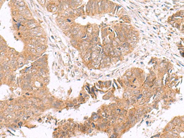 HMGCLL1 Antibody - Immunohistochemistry of paraffin-embedded Human colorectal cancer tissue  using HMGCLL1 Polyclonal Antibody at dilution of 1:70(×200)