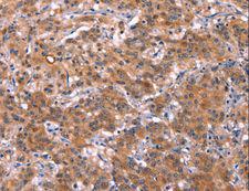 HMGCS1 / HMG-CoA Synthase 1 Antibody - Immunohistochemistry of paraffin-embedded Human gastric cancer using HMGCS1 Polyclonal Antibody at dilution of 1:40.