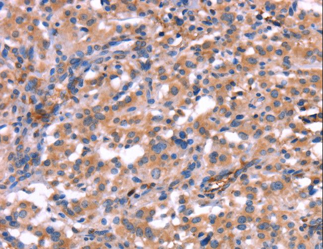 HMGCS1 / HMG-CoA Synthase 1 Antibody - Immunohistochemistry of paraffin-embedded Human thyroid cancer using HMGCS1 Polyclonal Antibody at dilution of 1:40.