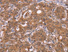 HMGCS1 / HMG-CoA Synthase 1 Antibody - Immunohistochemistry of paraffin-embedded Human liver cancer using HMGCS1 Polyclonal Antibody at dilution of 1:40.