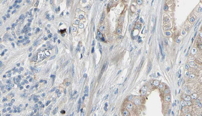 HMGCS1 / HMG-CoA Synthase 1 Antibody - 1:100 staining human prostate tissue by IHC-P. The sample was formaldehyde fixed and a heat mediated antigen retrieval step in citrate buffer was performed. The sample was then blocked and incubated with the antibody for 1.5 hours at 22°C. An HRP conjugated goat anti-rabbit antibody was used as the secondary.