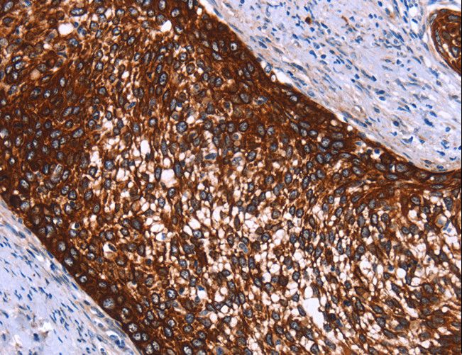 HMGCS2 / HMG-CoA Synthase 2 Antibody - Immunohistochemistry of paraffin-embedded Human cervical cancer using HMGCS2 Polyclonal Antibody at dilution of 1:40.