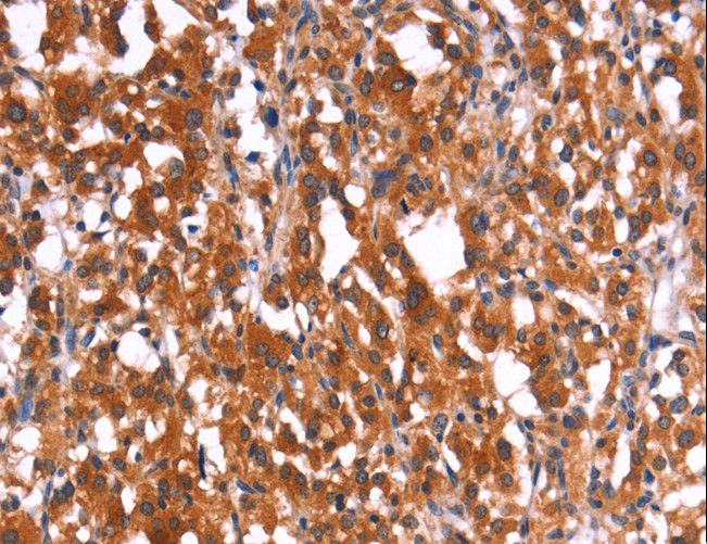 HMGCS2 / HMG-CoA Synthase 2 Antibody - Immunohistochemistry of paraffin-embedded Human thyroid cancer using HMGCS2 Polyclonal Antibody at dilution of 1:40.