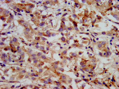 HMGCS2 / HMG-CoA Synthase 2 Antibody - Immunohistochemistry image at a dilution of 1:400 and staining in paraffin-embedded human liver cancer performed on a Leica BondTM system. After dewaxing and hydration, antigen retrieval was mediated by high pressure in a citrate buffer (pH 6.0) . Section was blocked with 10% normal goat serum 30min at RT. Then primary antibody (1% BSA) was incubated at 4 °C overnight. The primary is detected by a biotinylated secondary antibody and visualized using an HRP conjugated SP system.