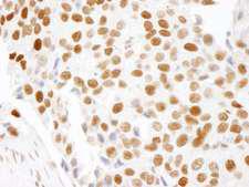 HMGN1 / HMG14 Antibody - Detection of Human HMGN1 by Immunohistochemistry. Sample: FFPE section of human breast carcinoma. Antibody: Affinity purified rabbit anti-HMGN1 used at a dilution of 1:250.