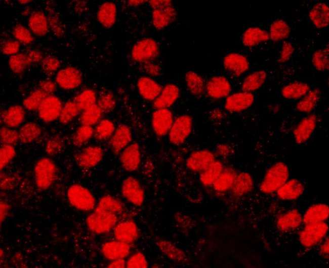 HMGN1 / HMG14 Antibody - Detection of Human HMGN1 by Immunofluorescence. Sample: FFPE section of human breast carcinoma. Antibody: Affinity purified rabbit anti-HMGN1 used at a dilution of 1:2000 (0.5 ug/ml)..Detection: Red-fluorescent Goat anti-Rabbit IgG-heavy and light chain cross-adsorbed Antibody DyLight 594 Conjugated (A120-601D4) used at a dilution of 1:100 (5 ug/ml).